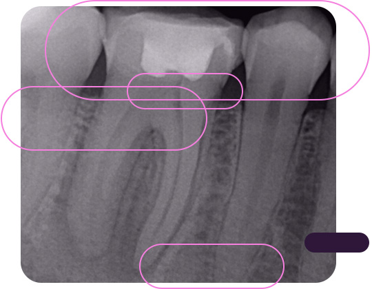 Radiografia Periapical