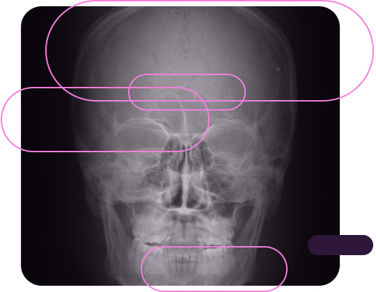 Telerradiografia Frontal