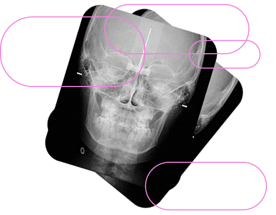 Verificação em norma frontal