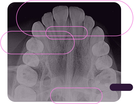 Radiografia Oclusal