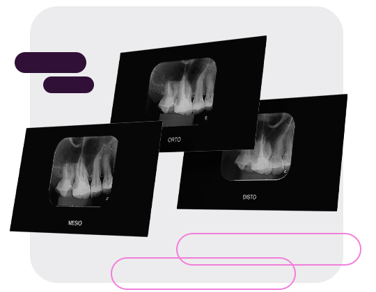 Radiografia Para Fins de Técnica de Localização Radiográfica